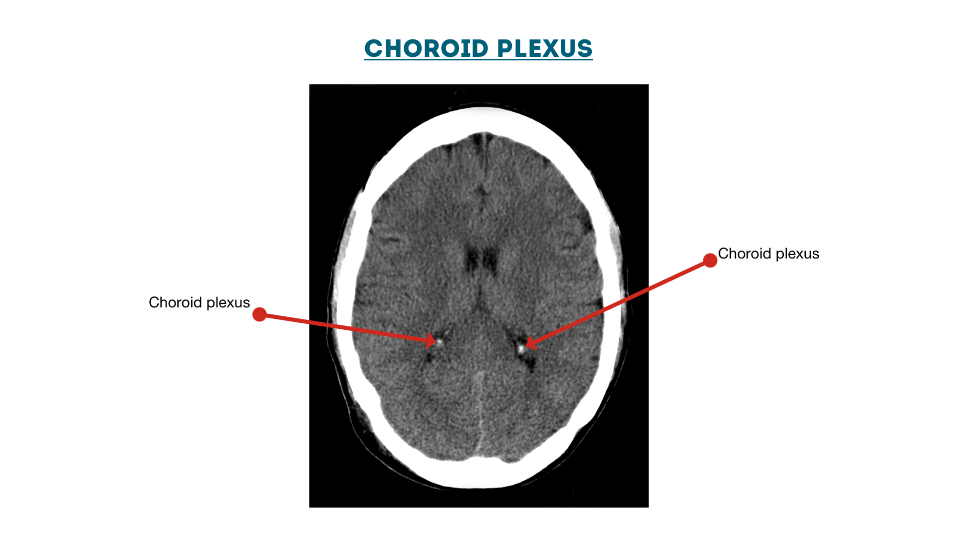 Figure 15 : Choroid Plexus