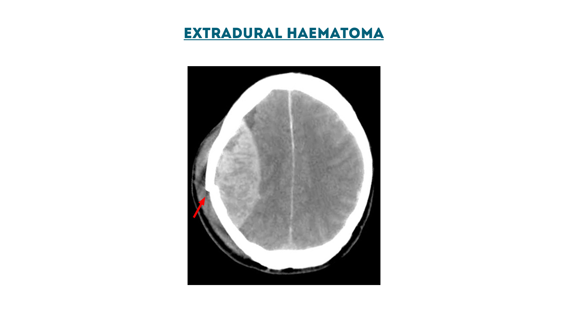 Figure 5 : Extradural haematoma