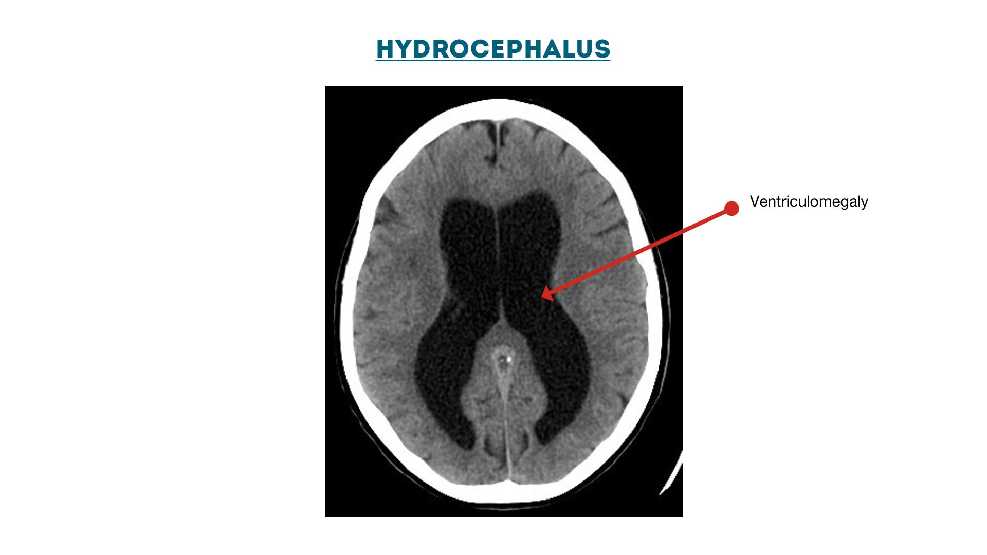 Figure 16 : Hydrocephalus: enlarged ventricles (ventriculomegaly)
