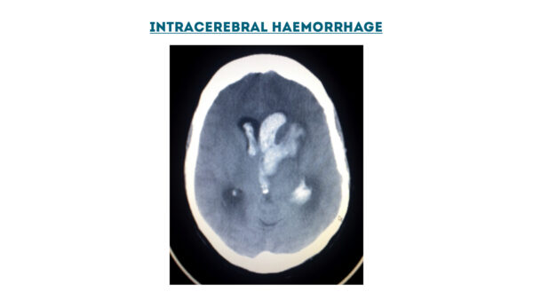 Intracerebral haemorrhage