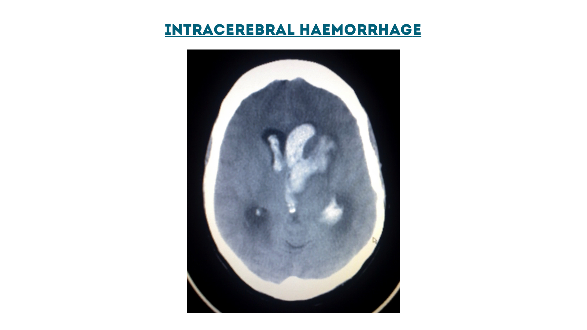Figure 8 : Intracerebral haemorrhage