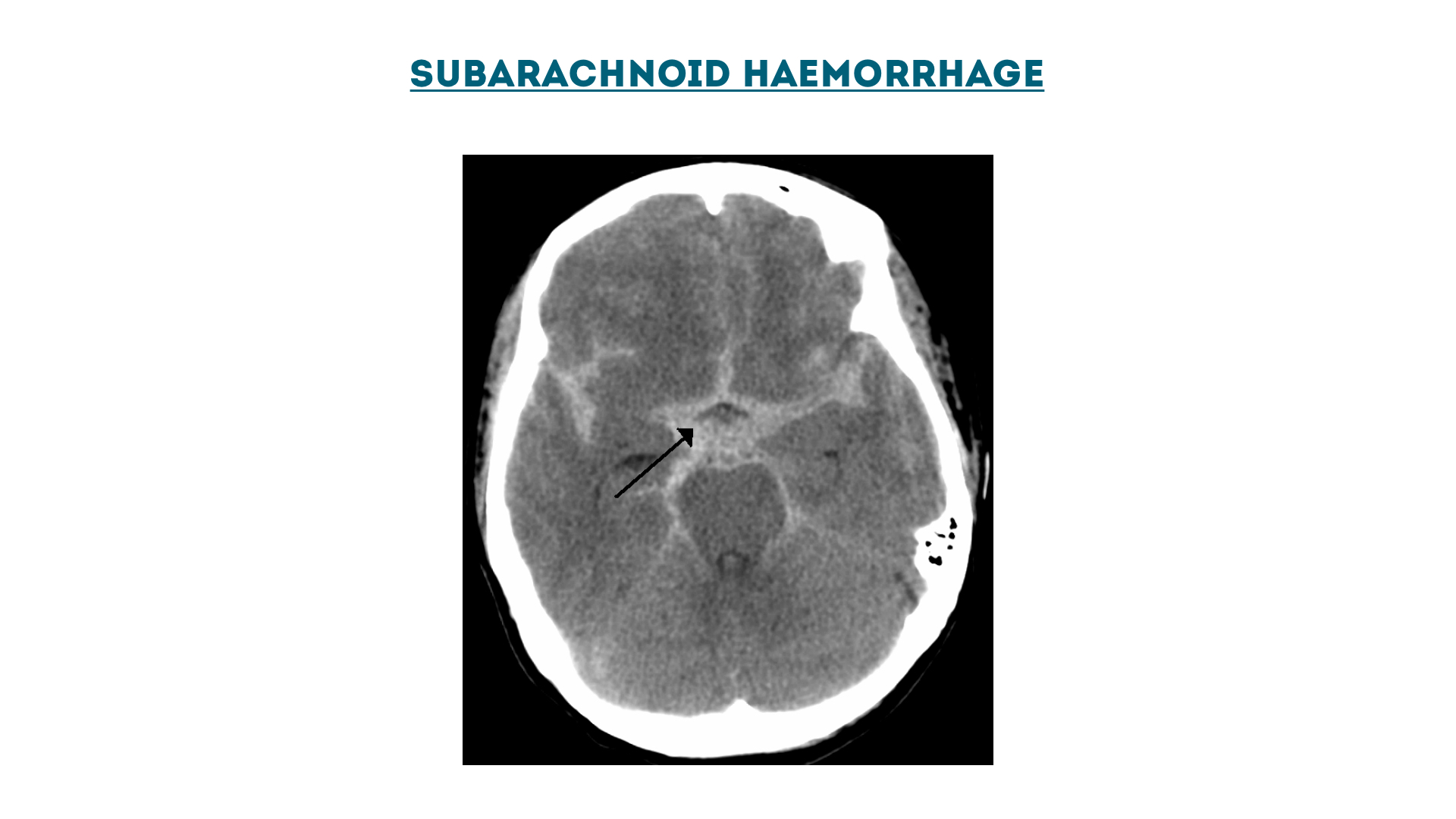 Figure 7 : Subarachnoid haemorrhage