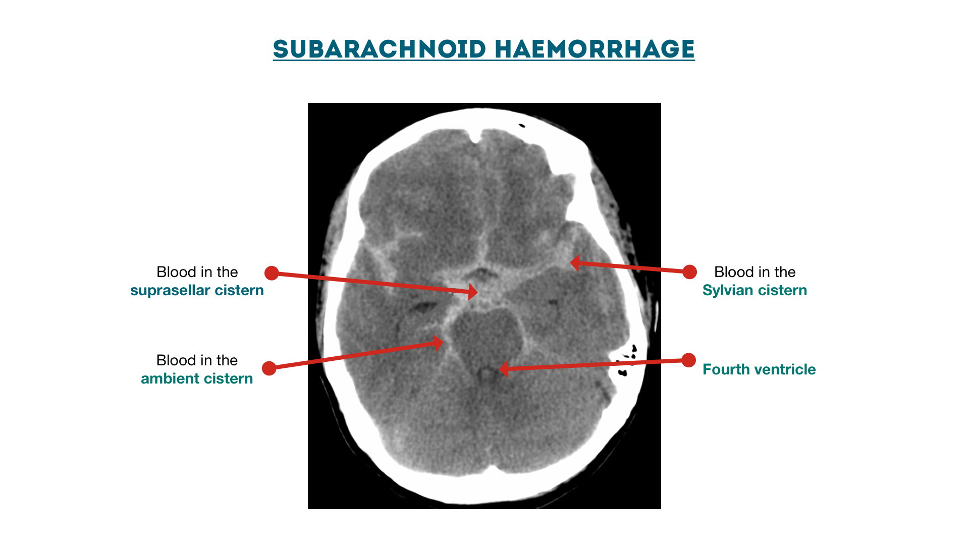 Figure 9 : An example of some of the subarachnoid cisterns made more visible due to the presence of blood from subarachnoid haemorrhage