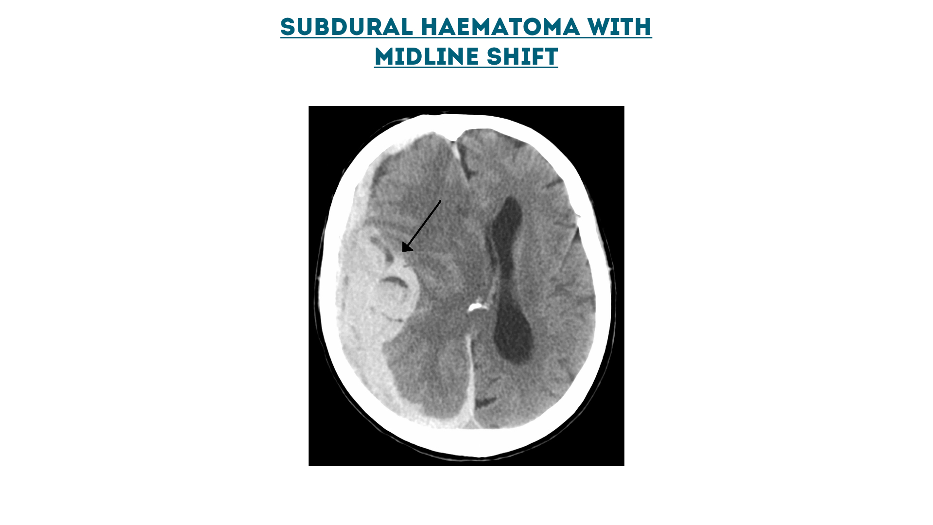 Figure 6 : Subdural haematoma