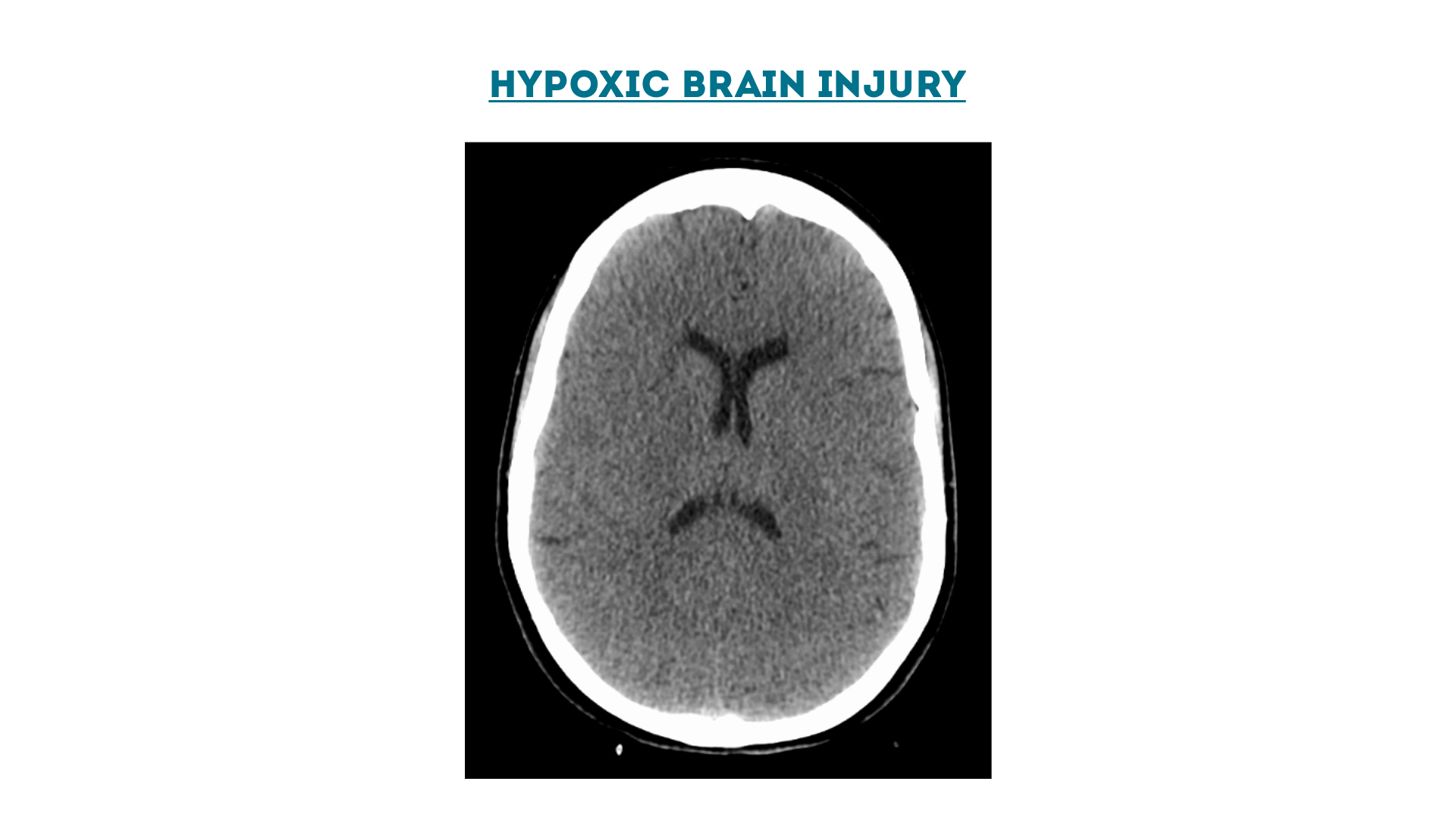 Figure 10 : Hypoxic Brain Injury