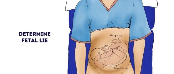 Obstetric abdominal examination (fetal lie)