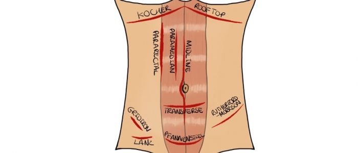 Abdominal incision types