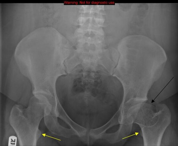 Perthes disease x-ray
