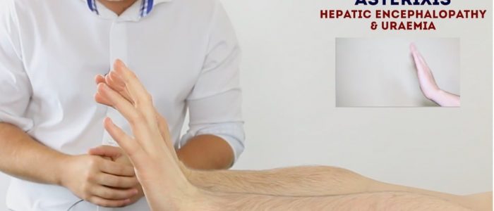 Hepatic flap (asterixis)