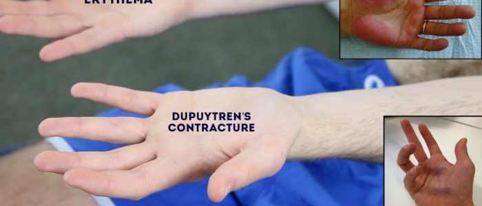 Dupuytren's contracture and Palmar erythema