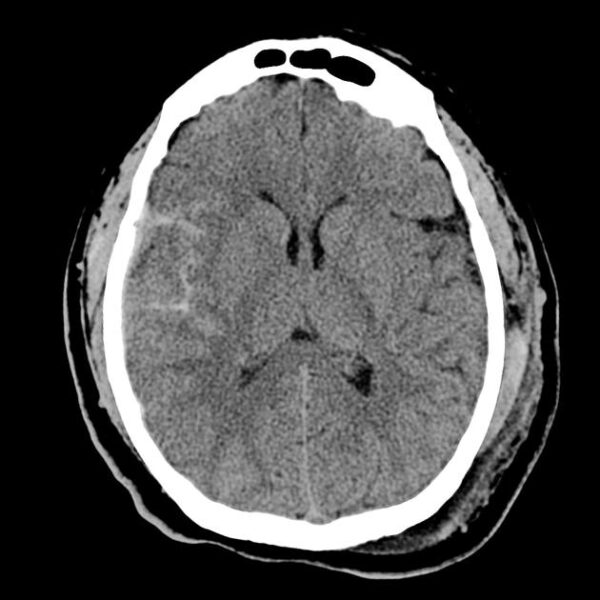 Non-contrast CT scan showing a traumatic subarachnoid haemorrhage