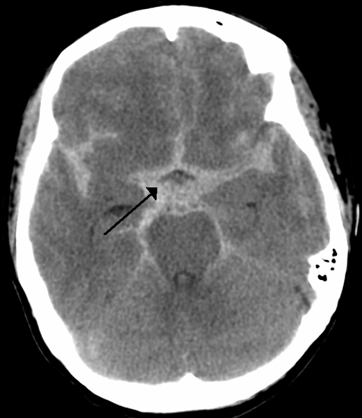 Non-contrast CT scan of a spontaneous sub-arachnoid haemorrhage