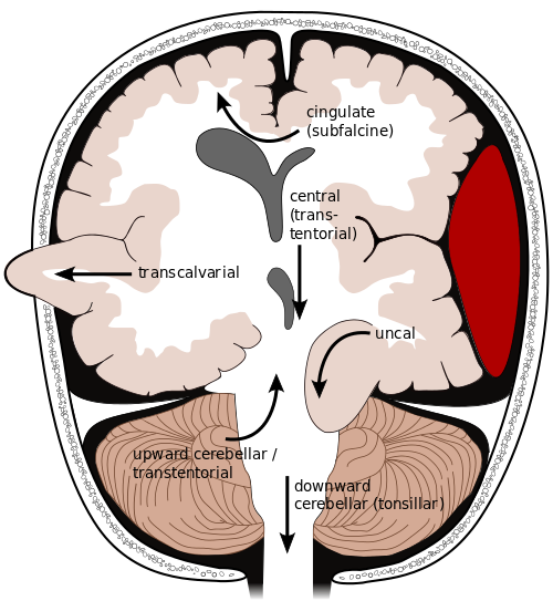 Diagram showing the different types of brain herniation