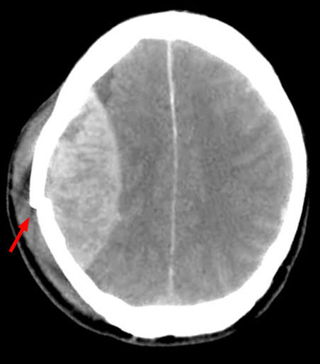 Non-contrast CT showing an EDH with a skull fracture marked by the arrow