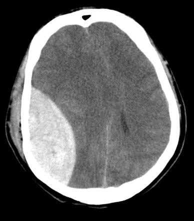Non-contrast CT Scan of an Extradural Haematoma