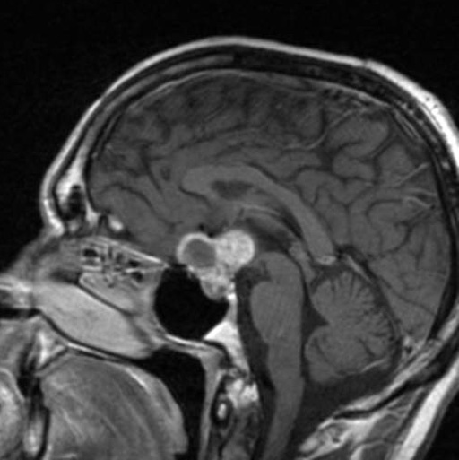 MRI of a Craniopharyngioma