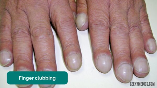 Finger clubbing