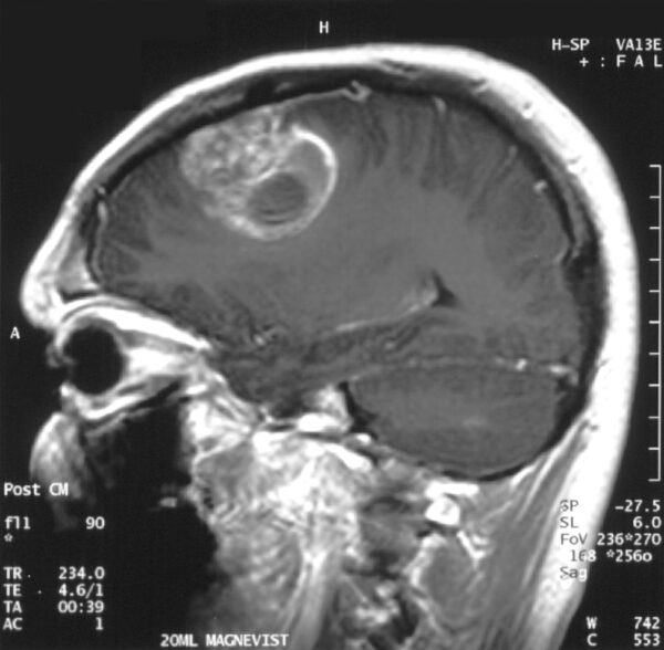 MRI with contrast of a GBM