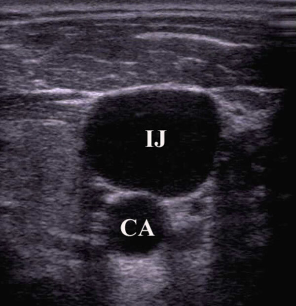 Cross-section of the carotid and IJV