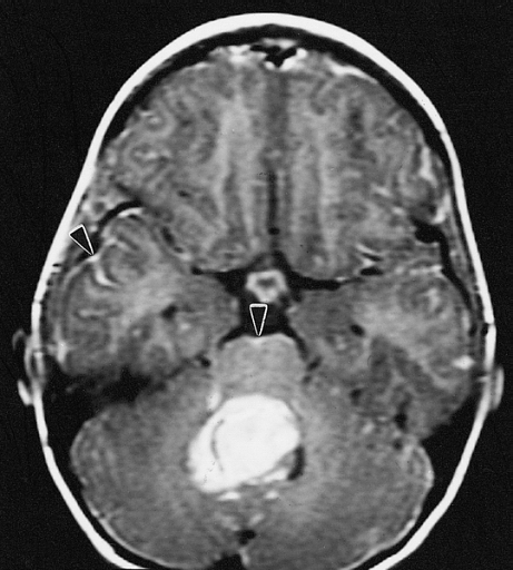 MRI of a medulloblastoma (as indicated by arrows)