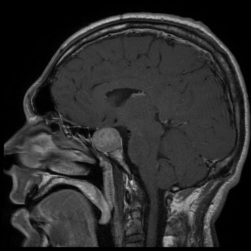 MRI of a Pituitary adenoma