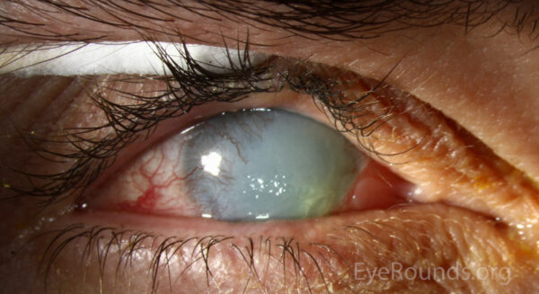 Chemical eye injury