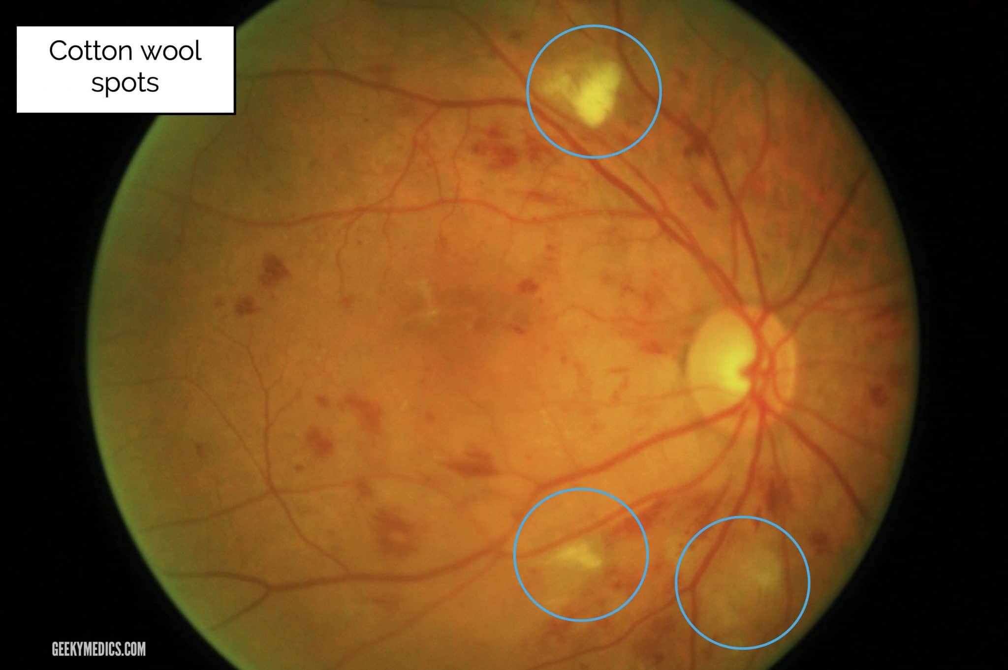 Retina oftalmoscopy