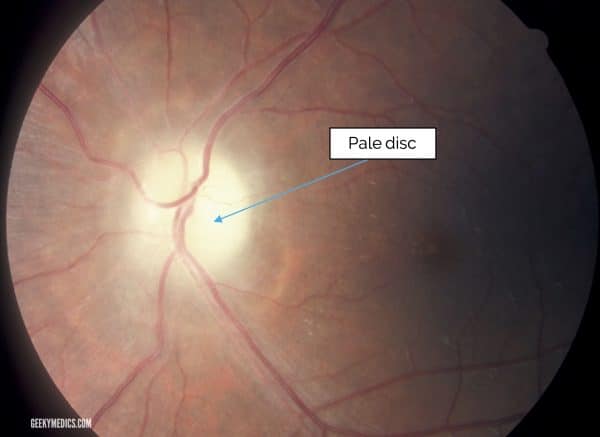 Optic Nerve Atrophy (Pale Optic Disc)