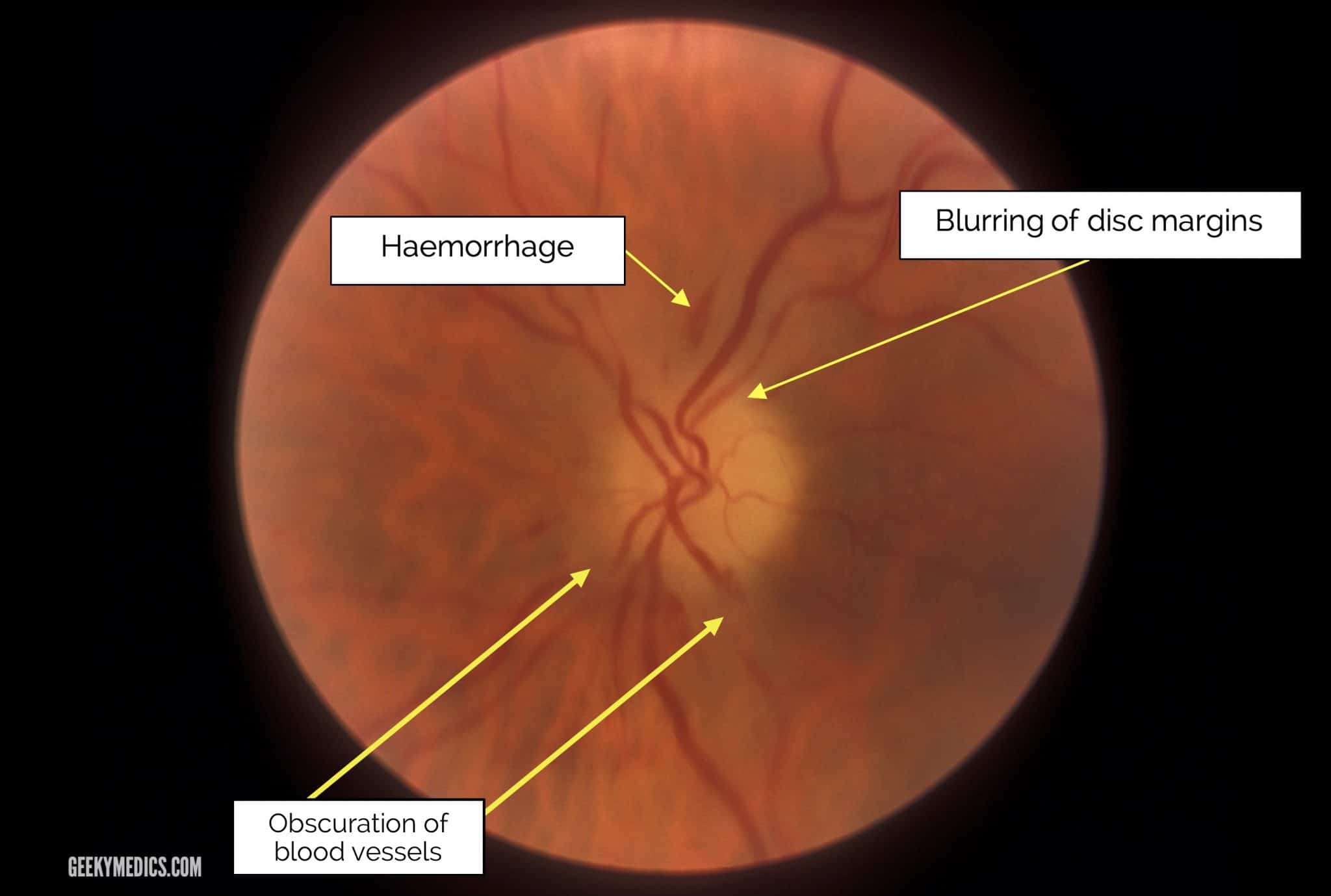 papilledema vs glaucoma