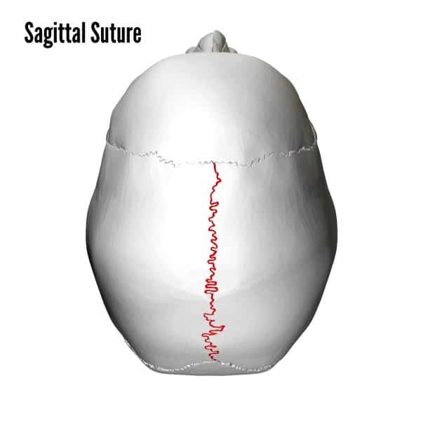 Sagittal suture