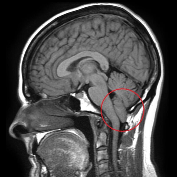 Type 1 chiari malformation on MRI shown in red circle