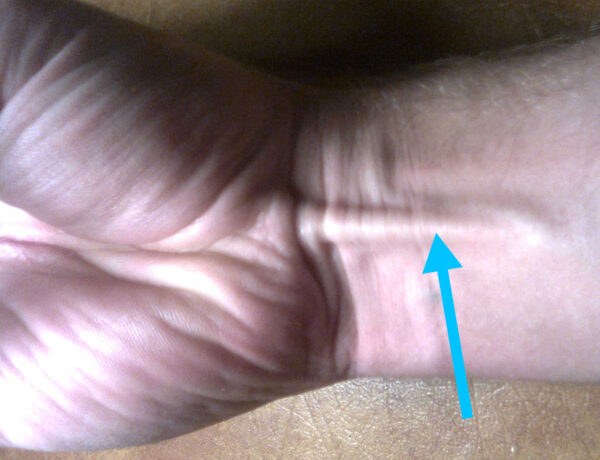 Palmaris longus tendon
