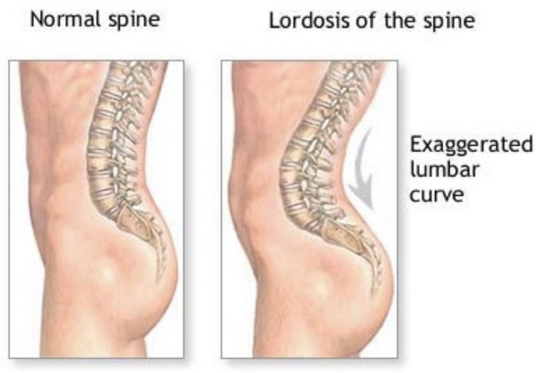 Note the lumbar lordosis present as an exaggerated lumbar curvature. The hips are tilted anteriorly.
