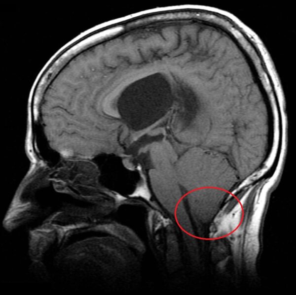 Type 2 chiari malformation, shown in red, on an MRI scan