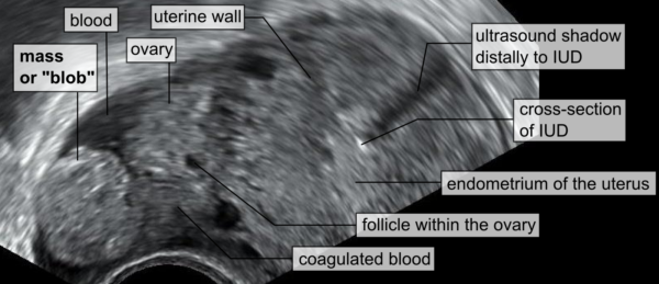 Ectopic pregnancy ultrasound