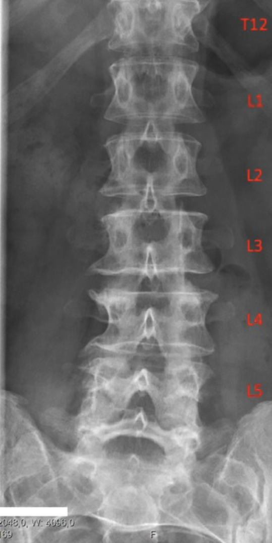 Lumbar spine radiograph
