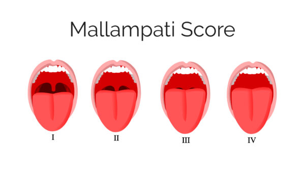 Mallampati score