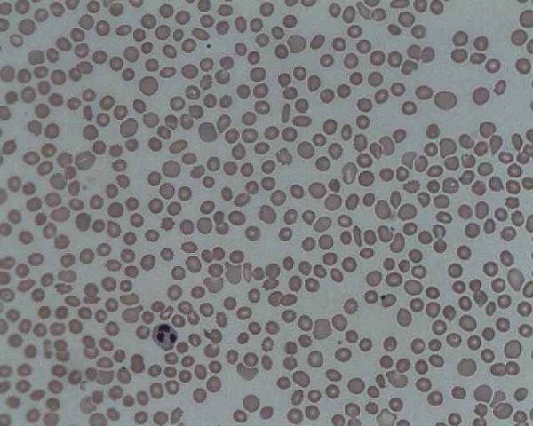 Thrombocytopenia blood film