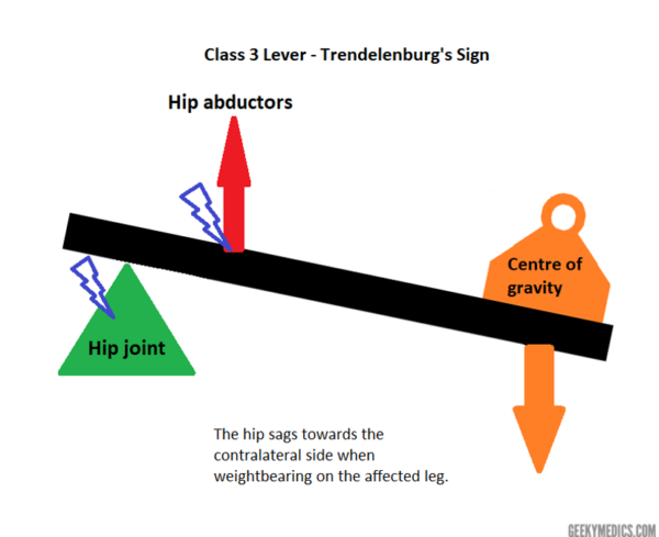 Trendelenburg’s sign in the hip
