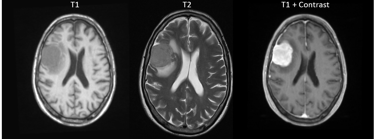 Mri blood weighted t1 The Usefulness