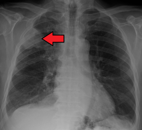 Chest x-ray showing lung cancer in the right upper zone
