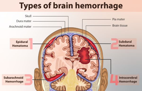 Different types of intracranial haemorrhages