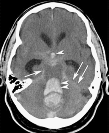 CT image of subarachnoid haemorrhage
