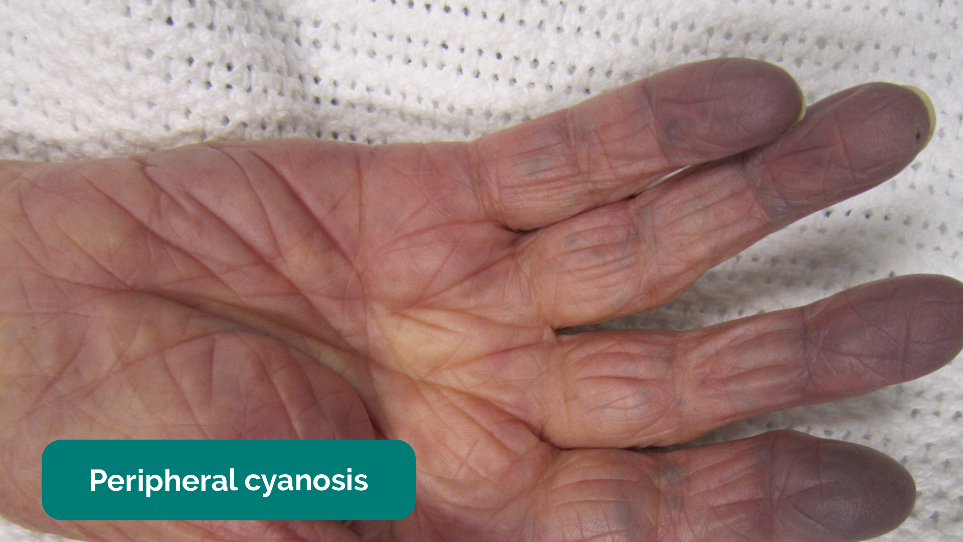 what is acute cyanosis