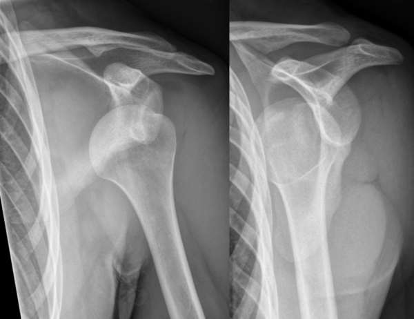 Anterior shoulder dislocation