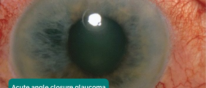 Acute angle-closure glaucoma