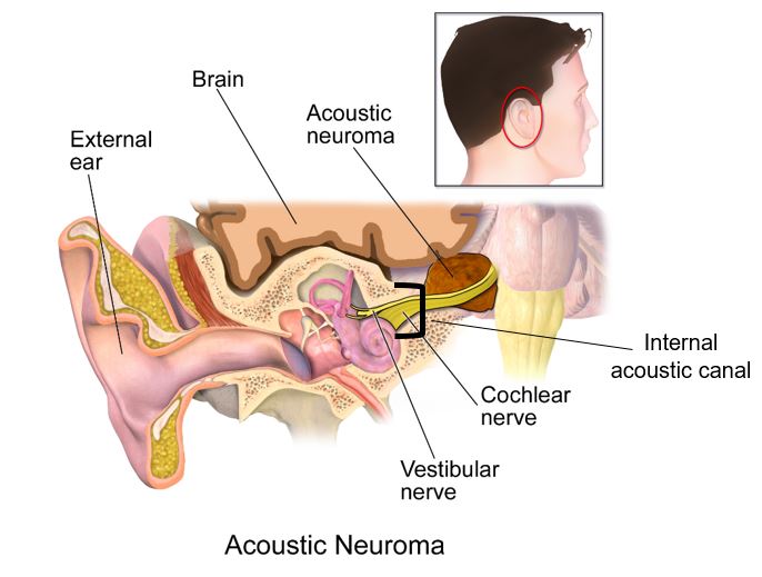 Acoustic Neuroma (Vestibular Schwannoma)