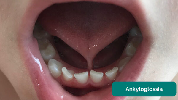 Ankyloglossia (tongue tie) 