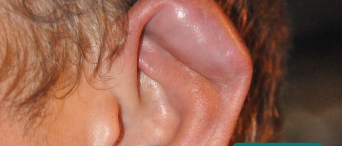 Cauliflower ear