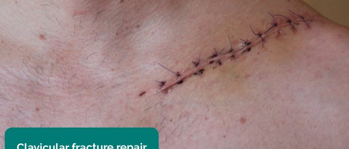 Clavicular fracture repair